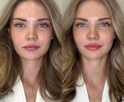 Dermal Fillers Before & After Gallery - Patient 105460 - Image 1