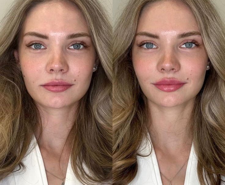 Dermal Fillers Before & After Gallery - Patient 105460 - Image 1