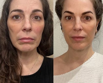 Sculptra Before & After Gallery - Patient 144380 - Image 1