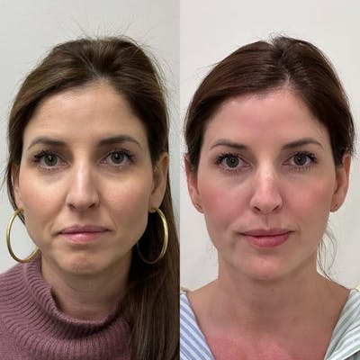 Sculptra Before & After Gallery - Patient 130998 - Image 1