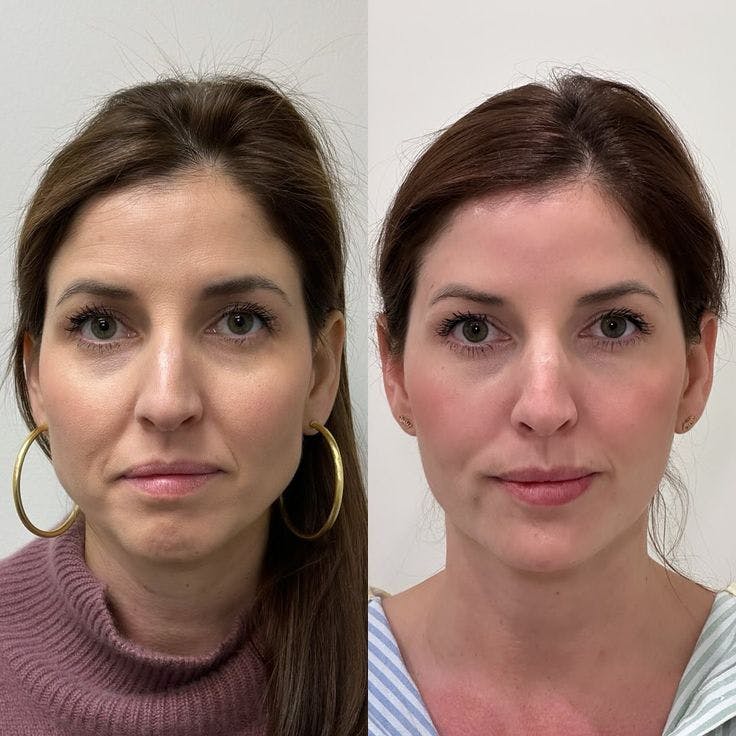 Sculptra Before & After Gallery - Patient 130998 - Image 1