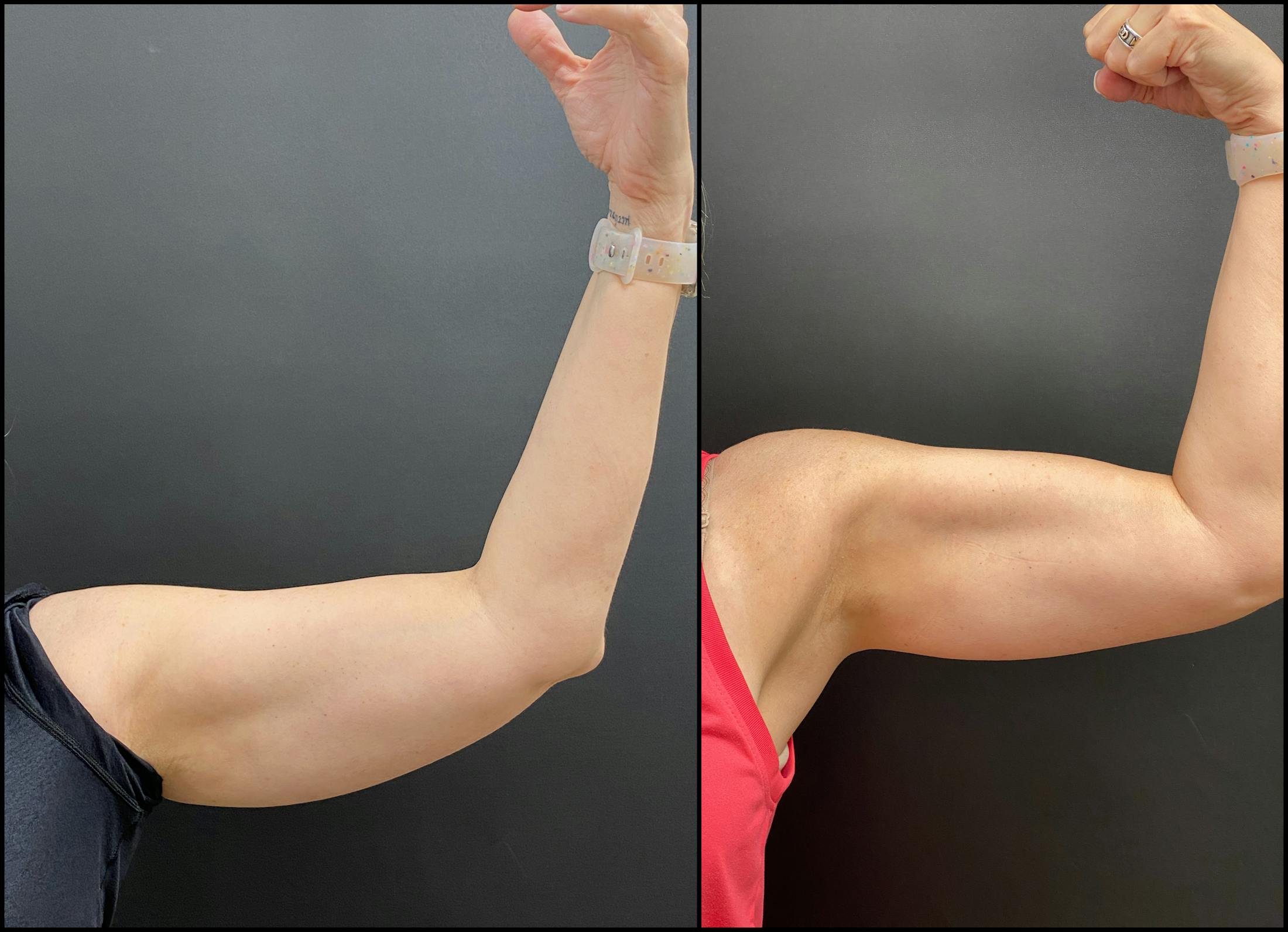 EvolveX Before & After Gallery - Patient 343745 - Image 1