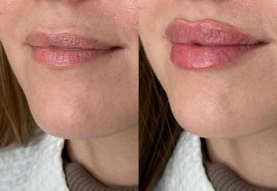 Dermal Fillers Before & After Gallery - Patient 239546 - Image 1