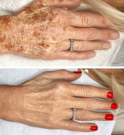 Dermal Fillers Before & After Gallery - Patient 846343 - Image 1