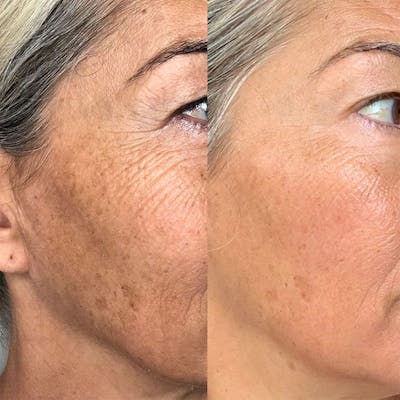 IPL for Face Before & After Gallery - Patient 946433 - Image 1