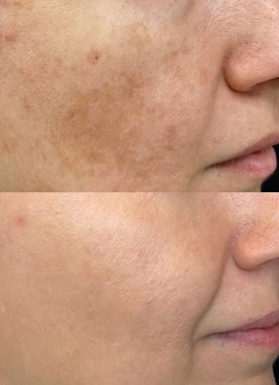 IPL for Face Before & After Gallery - Patient 766660 - Image 1