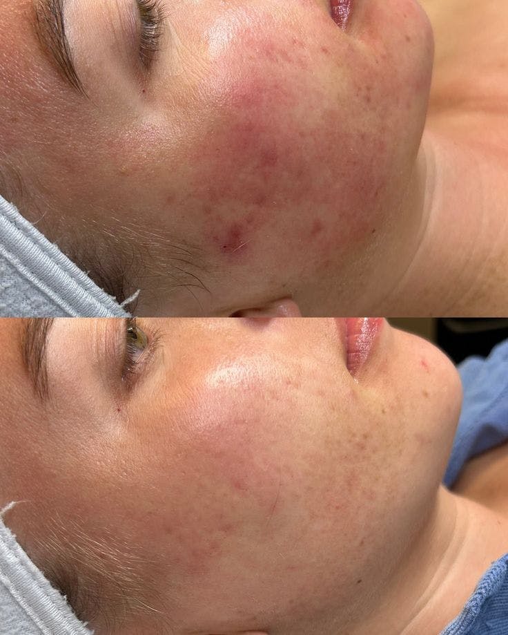 Medical Grade Facial  Before & After Gallery - Patient 300209 - Image 1