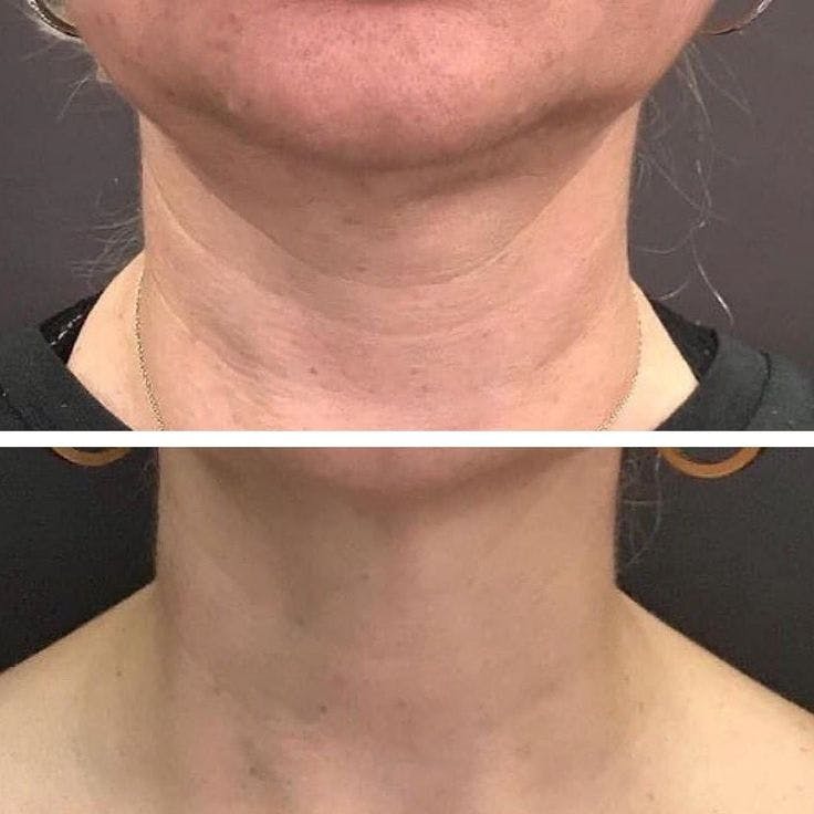 Morpheus8 Before & After Gallery - Patient 380266 - Image 1