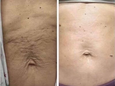 Morpheus8 for Body Before & After Gallery - Patient 318266 - Image 1
