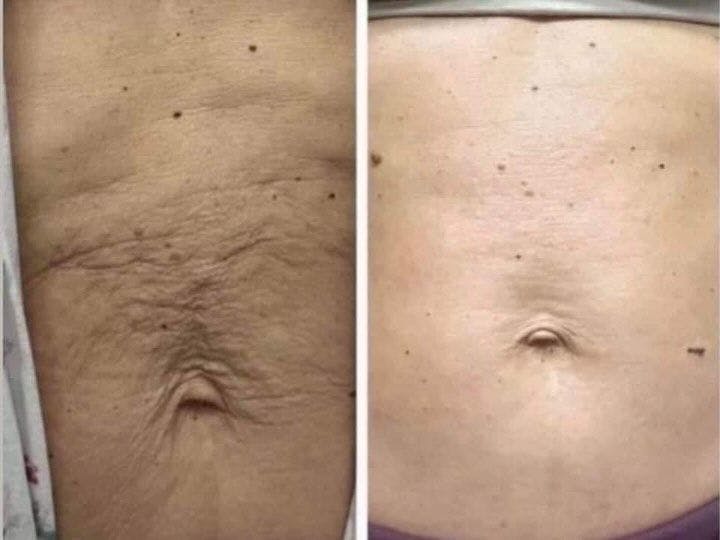 Morpheus8 for Body Before & After Gallery - Patient 318266 - Image 1