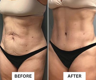 Weight Management Before & After Gallery - Patient 182716 - Image 1