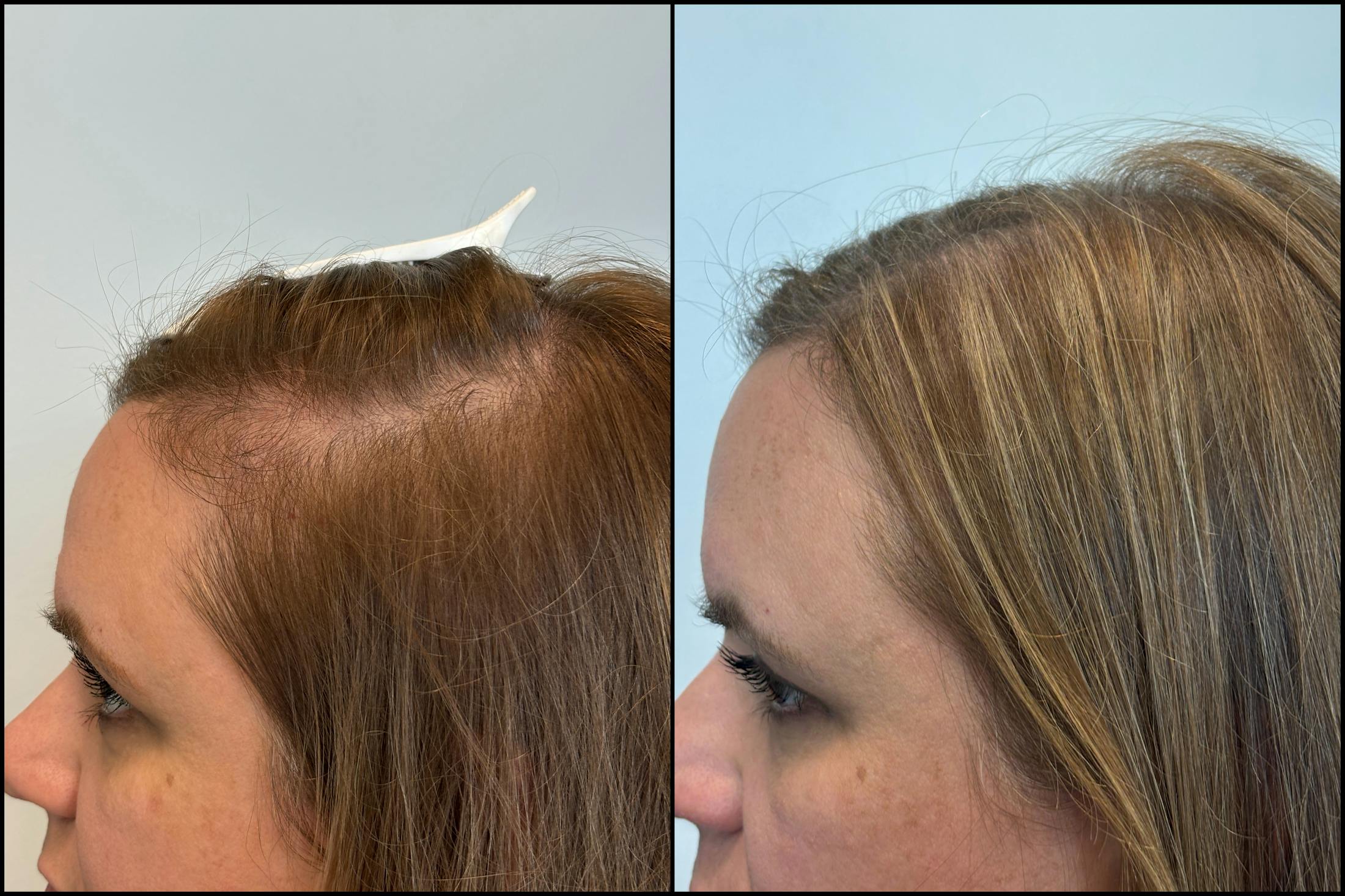PRP Hair Restoration Before & After Gallery - Patient 877818 - Image 1