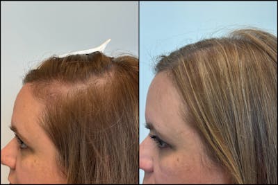 PRP Hair Restoration Before & After Gallery - Patient 877818 - Image 1