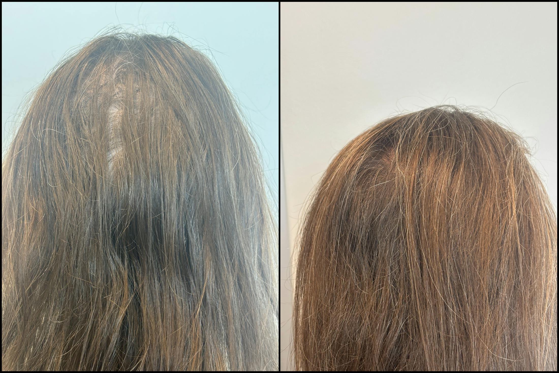 PRP Hair Restoration Before & After Gallery - Patient 264539 - Image 1