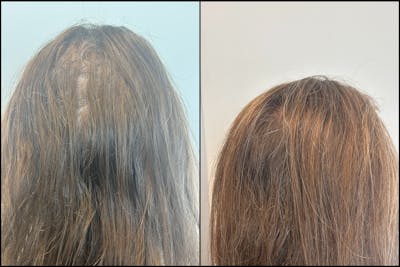 PRP Hair Restoration Before & After Gallery - Patient 264539 - Image 1