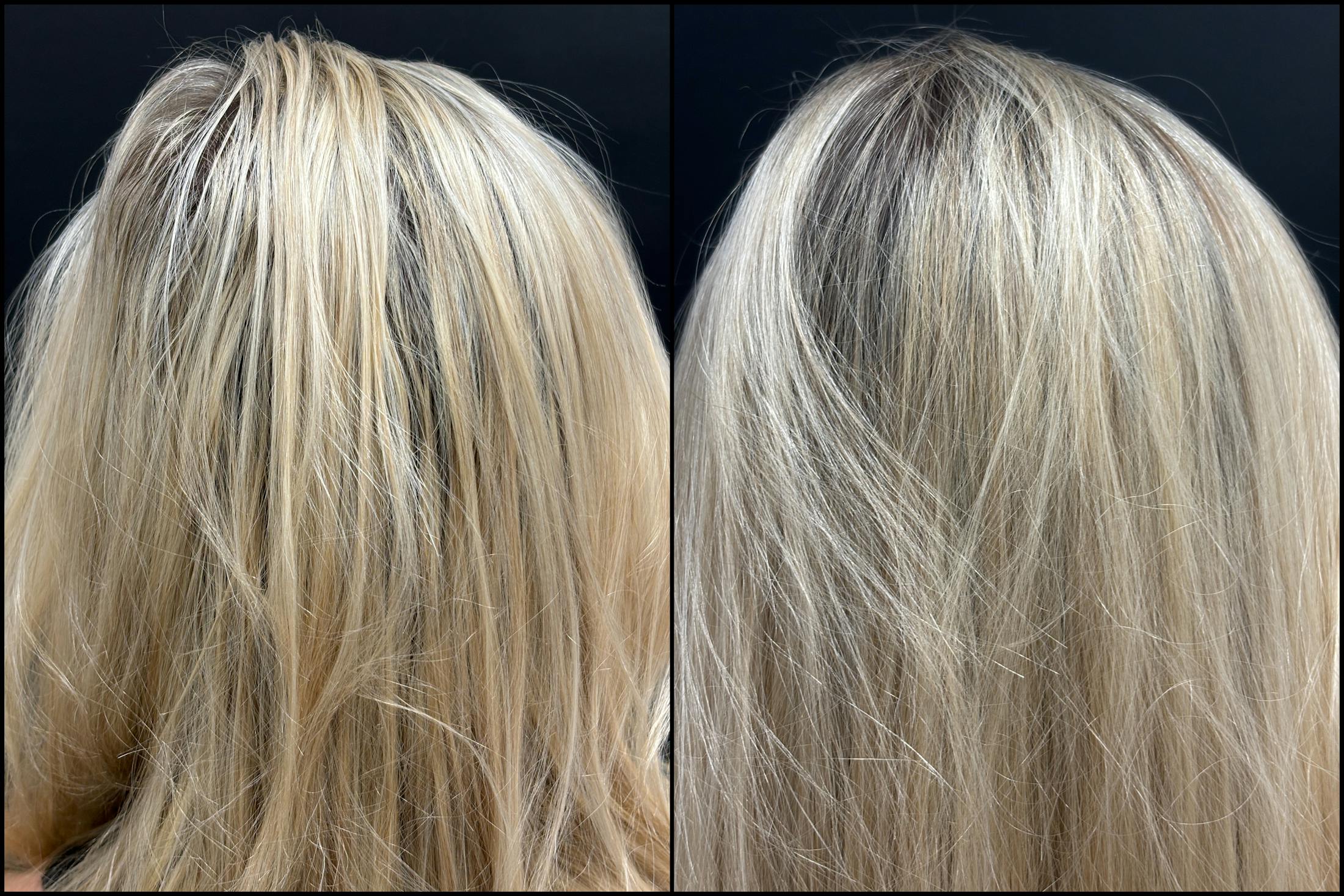 PRP Hair Restoration Before & After Gallery - Patient 100510 - Image 1