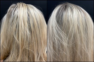PRP Hair Restoration Before & After Gallery - Patient 100510 - Image 1