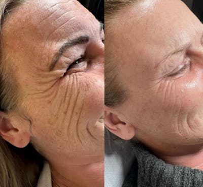Morpheus8 Before & After Gallery - Patient 398786 - Image 1