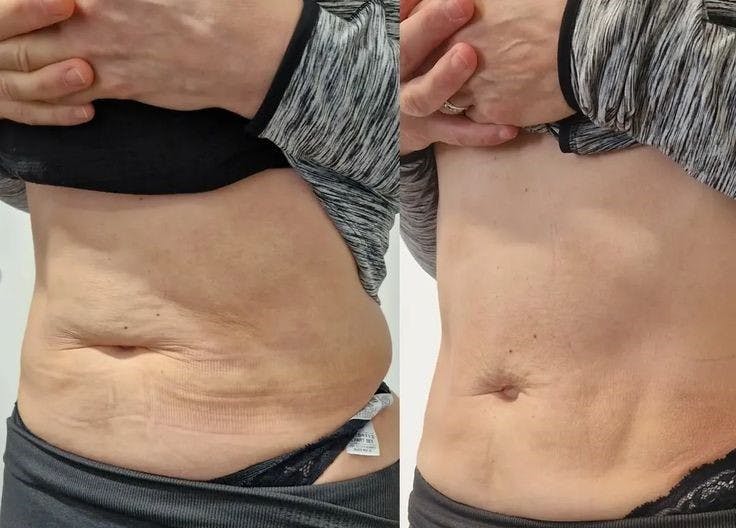 Morpheus8 for Body Before & After Gallery - Patient 362016 - Image 1