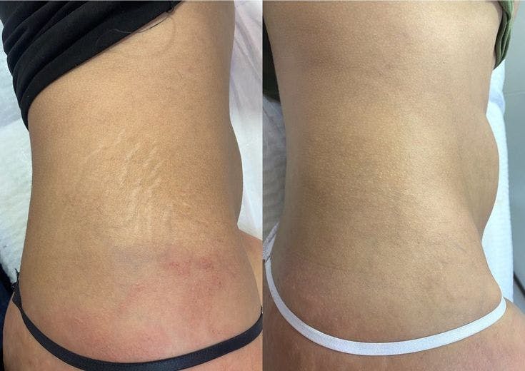 Morpheus8 for Body Before & After Gallery - Patient 349247 - Image 1