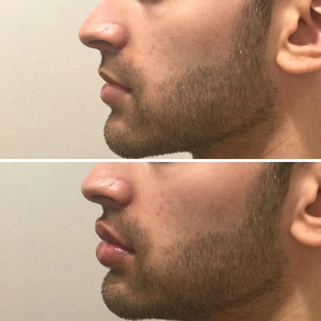 Dermal Fillers Before & After Gallery - Patient 235826 - Image 1