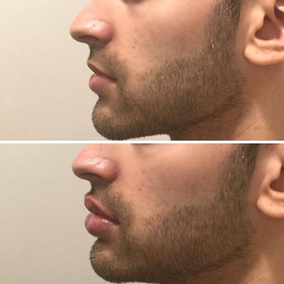 Dermal Fillers Before & After Gallery - Patient 235826 - Image 1