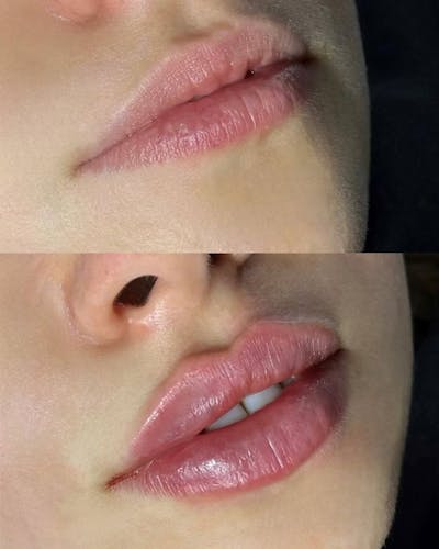 Dermal Fillers Before & After Gallery - Patient 362481 - Image 1
