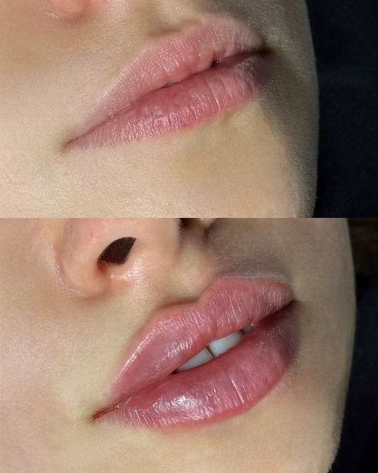 Dermal Fillers Before & After Gallery - Patient 362481 - Image 1