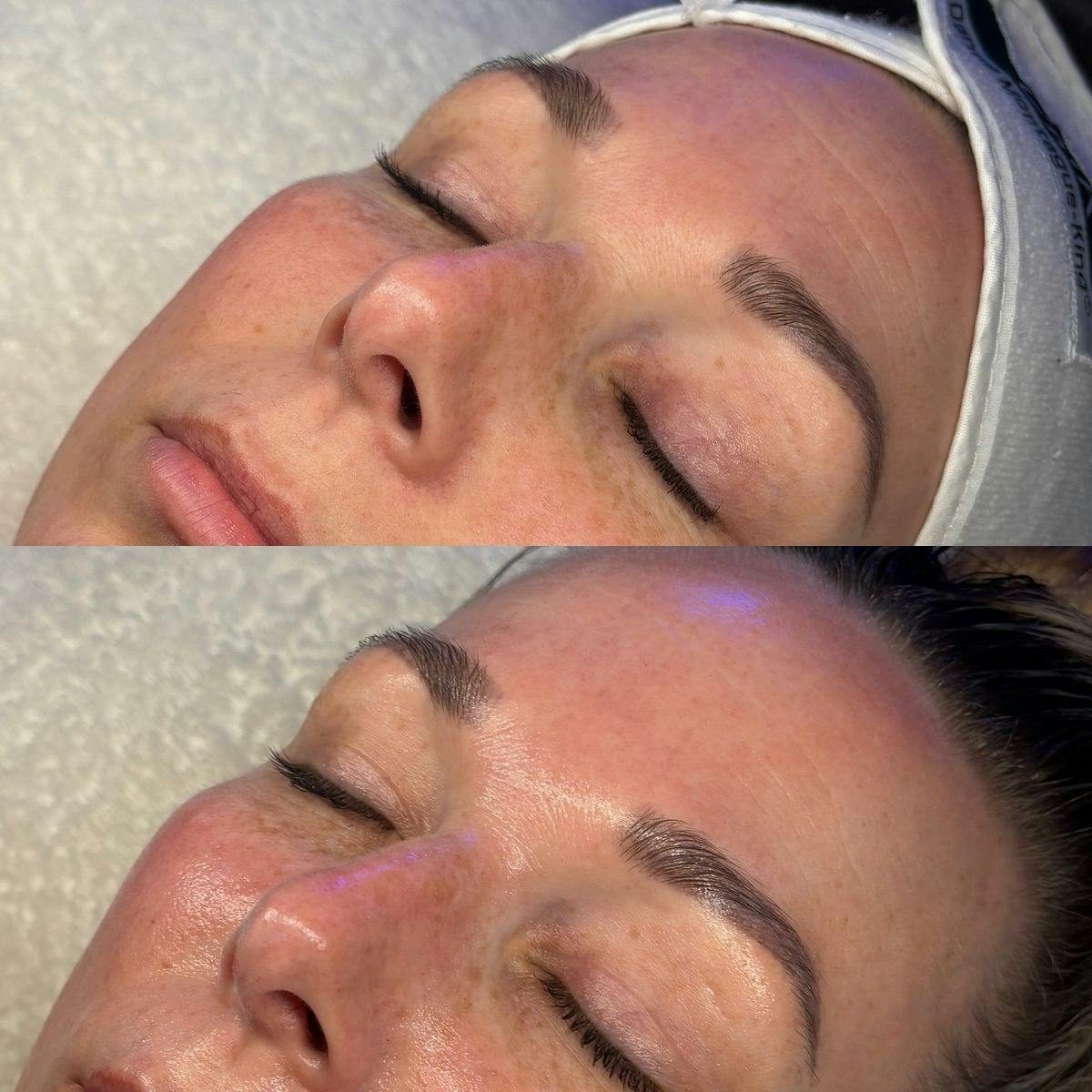 Medical Grade Facial  Before & After Gallery - Patient 134054 - Image 1