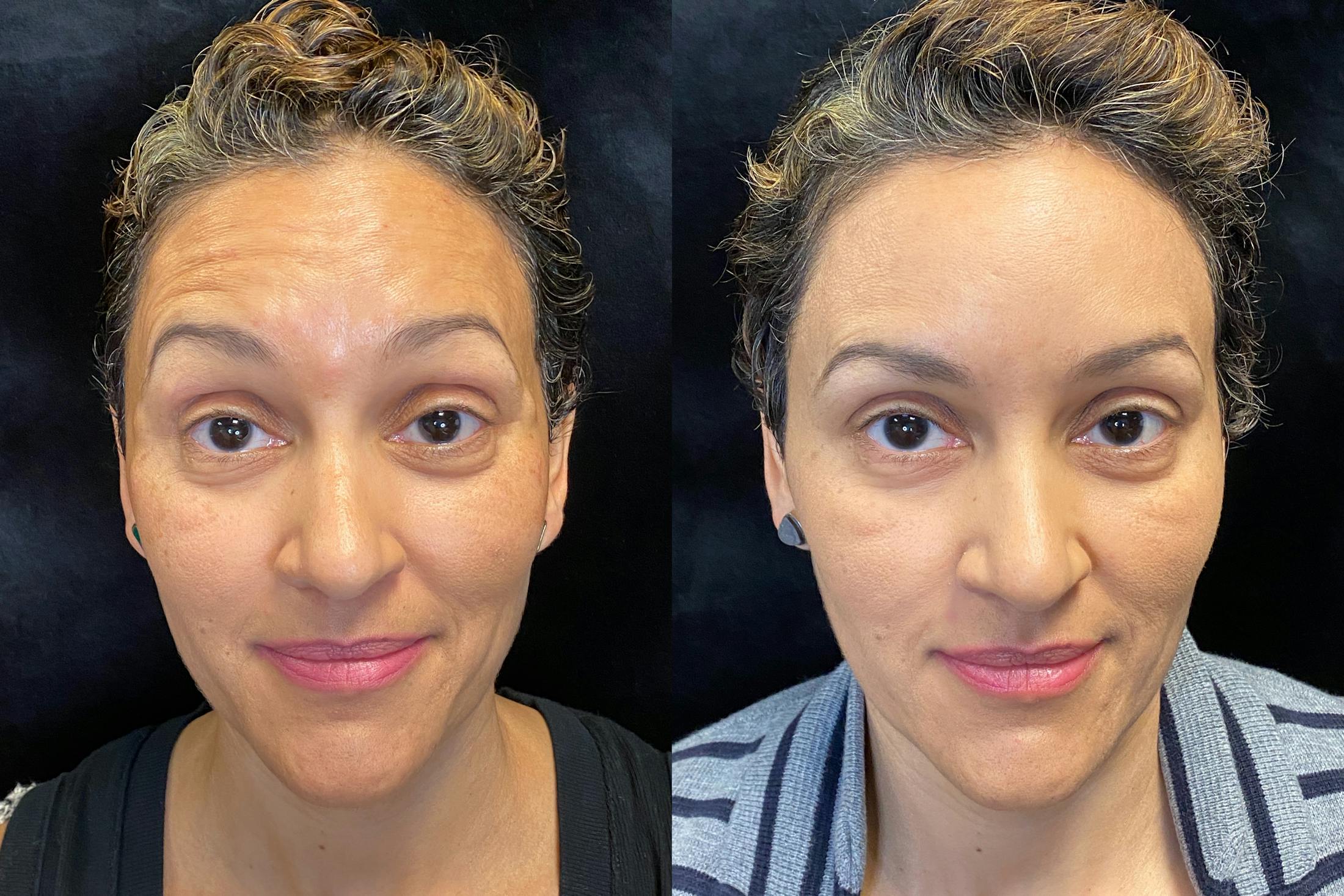 BOTOX/Dysport Before & After Gallery - Patient 151428 - Image 1