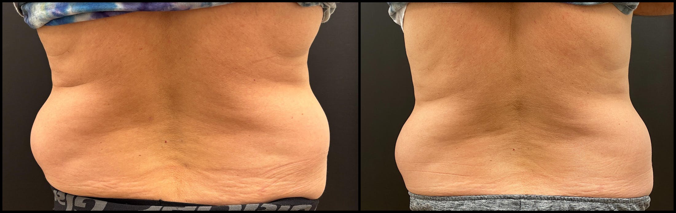 EvolveX Before & After Gallery - Patient 136817 - Image 2
