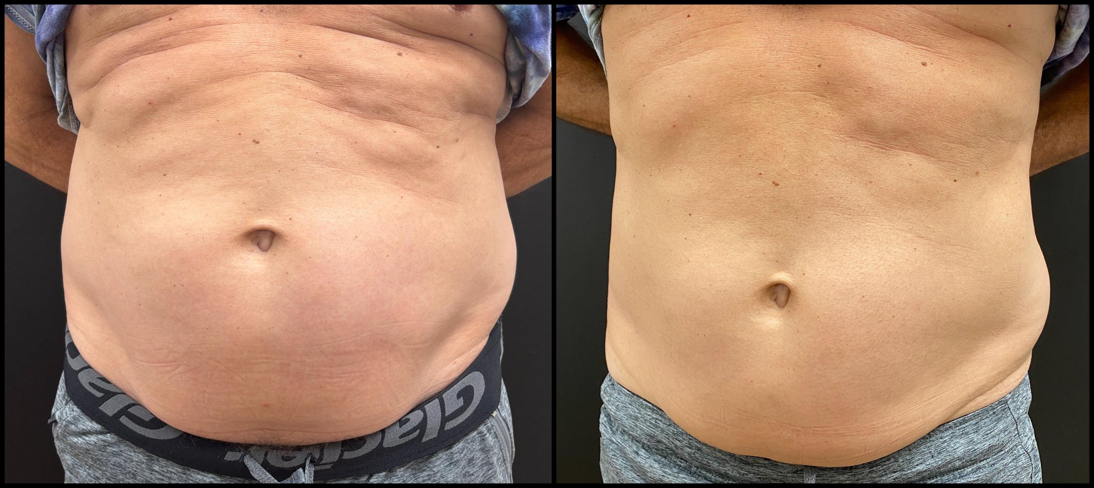 EvolveX Before & After Gallery - Patient 136817 - Image 1
