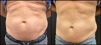 EvolveX Before & After Gallery - Patient 136817 - Image 1