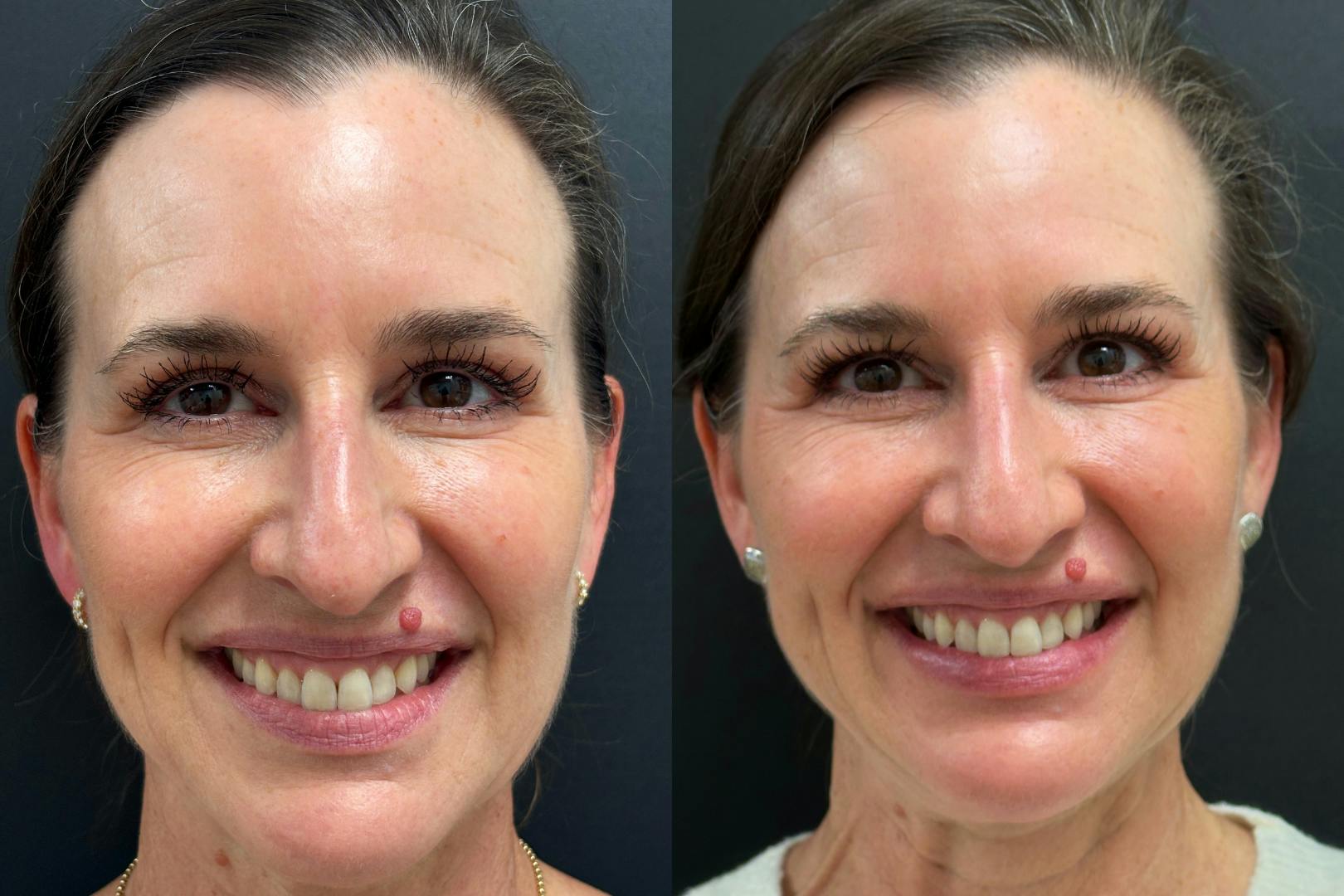 Dermal Fillers Before & After Gallery - Patient 118155 - Image 1