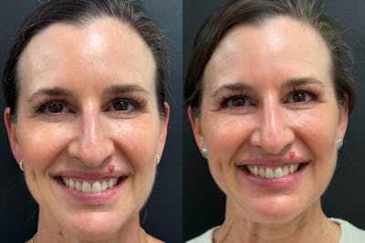Hyaluronic Acid Injections Before & After Gallery - Patient 118155 - Image 1