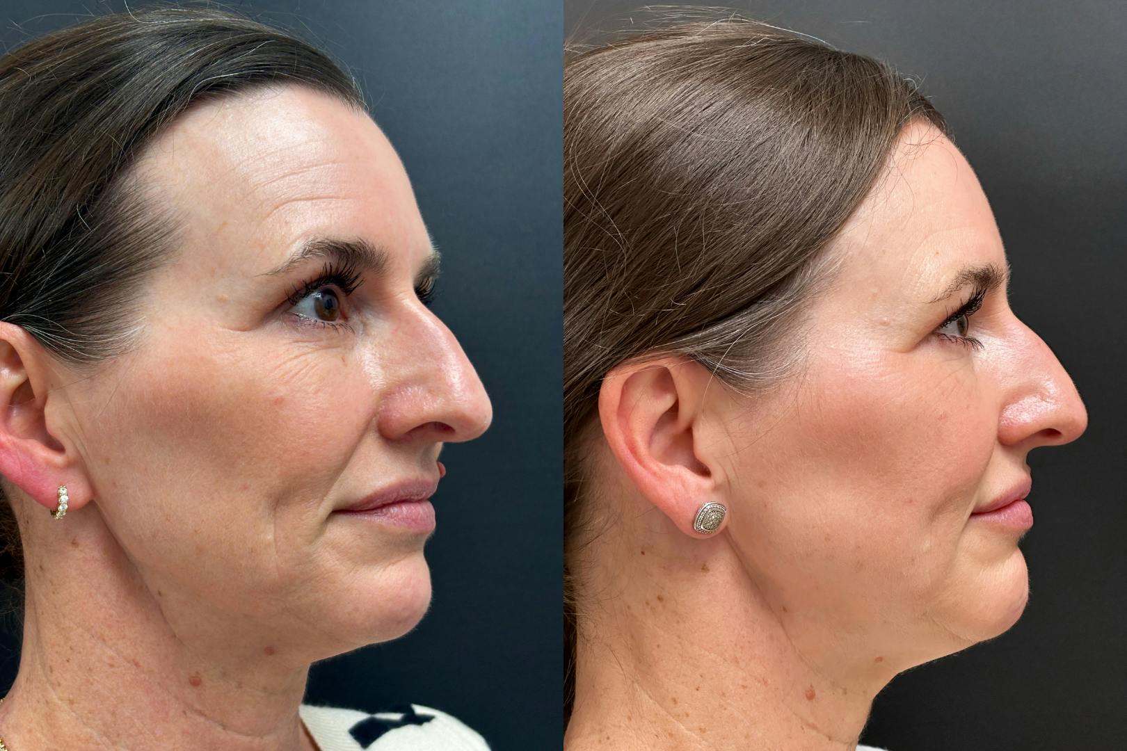 Dermal Fillers Before & After Gallery - Patient 118155 - Image 2