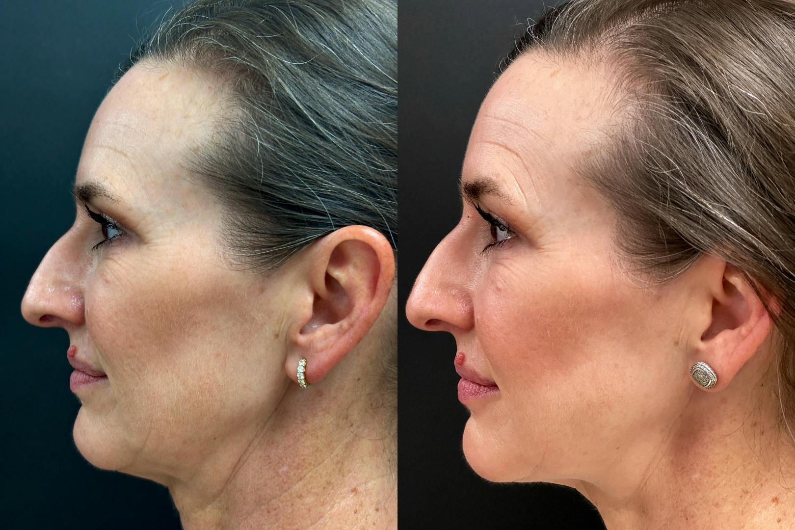 Dermal Fillers Before & After Gallery - Patient 118155 - Image 3