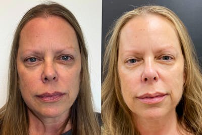 PRP Eye Rejuvenation Before & After Gallery - Patient 269713 - Image 1