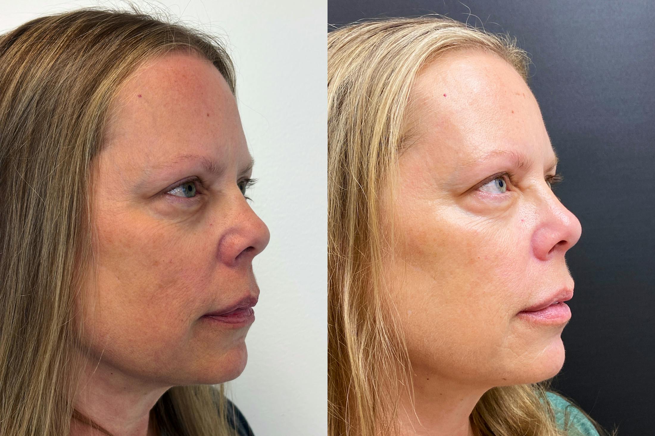 PRP Eye Rejuvenation Before & After Gallery - Patient 269713 - Image 2