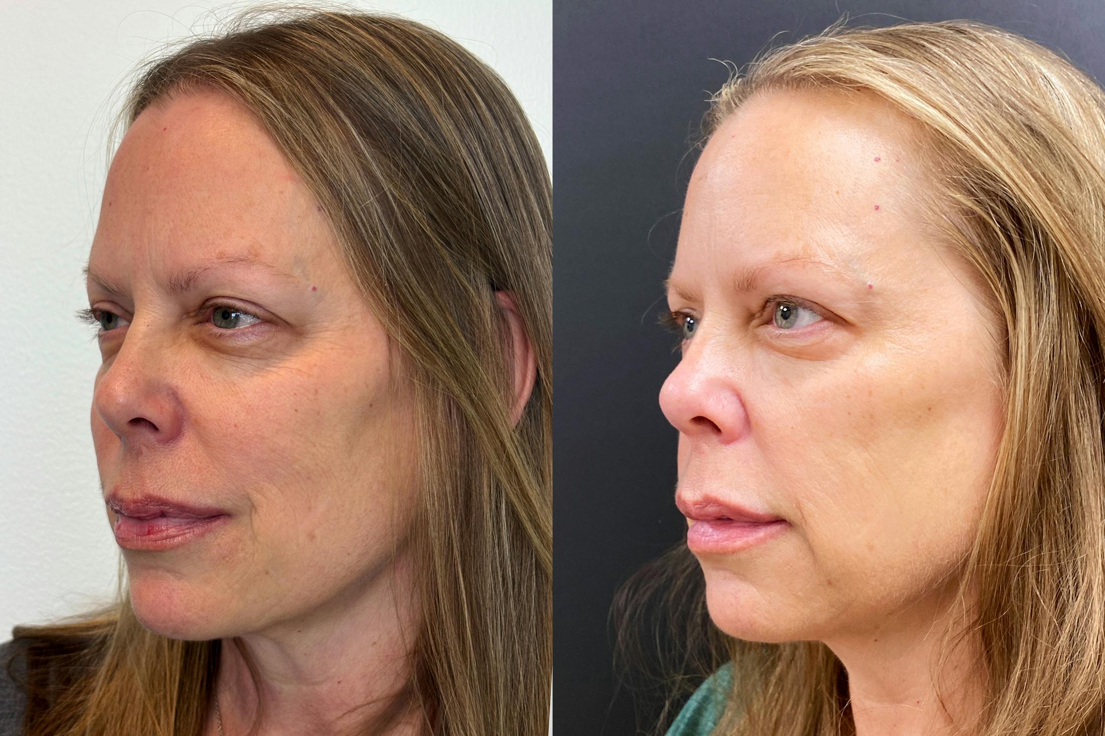 PRP Eye Rejuvenation Before & After Gallery - Patient 269713 - Image 3