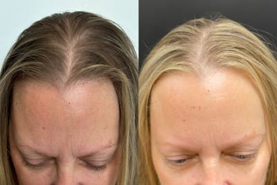 PRP Hair Restoration Before & After Gallery - Patient 120928 - Image 1
