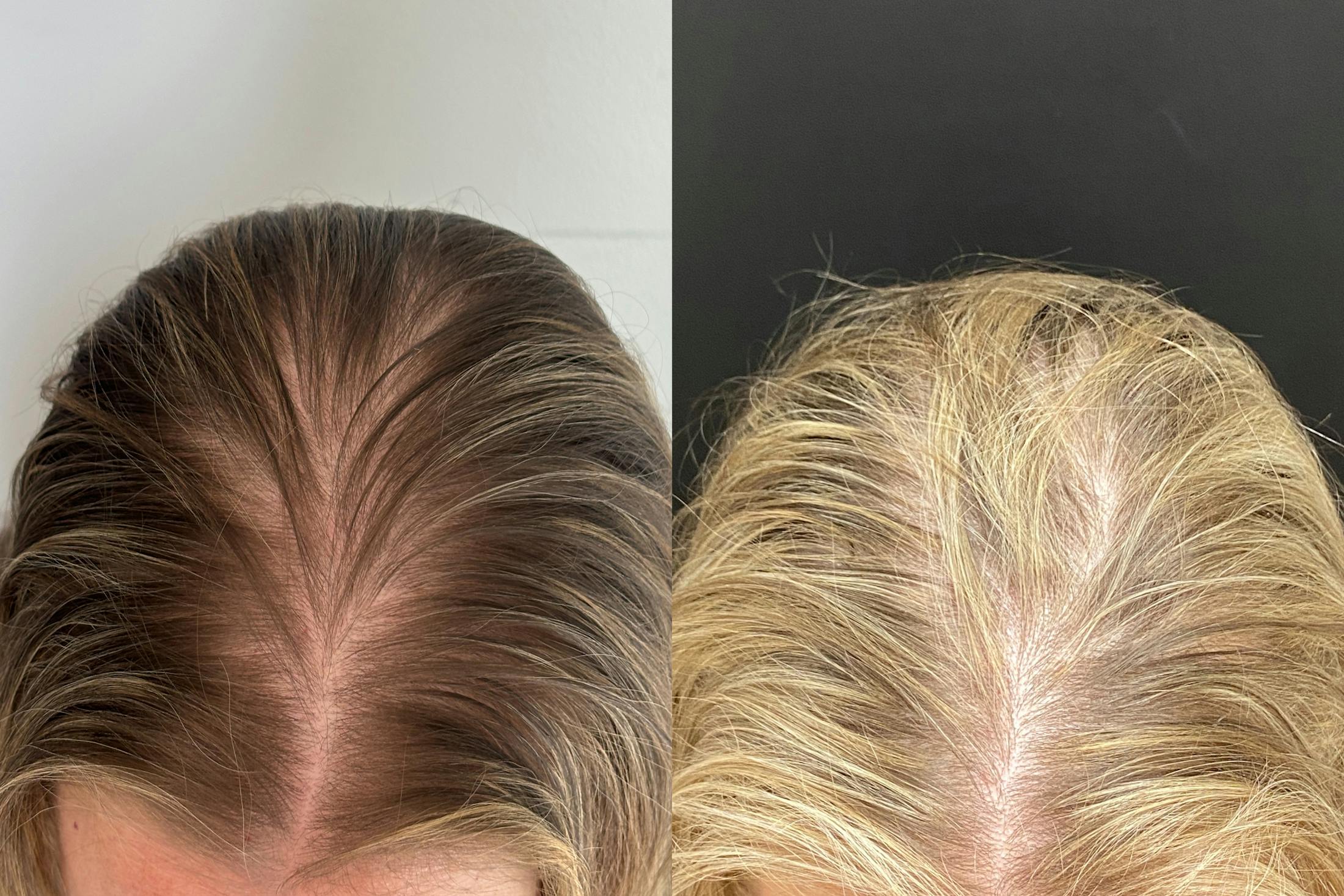 PRP Hair Restoration Before & After Gallery - Patient 120928 - Image 2