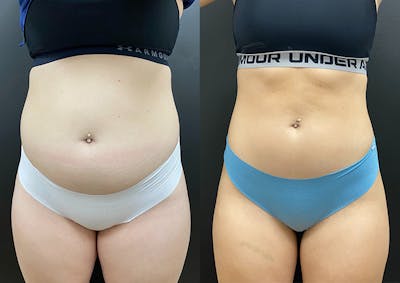 Morpheus8 for Body Before & After Gallery - Patient 248458 - Image 1