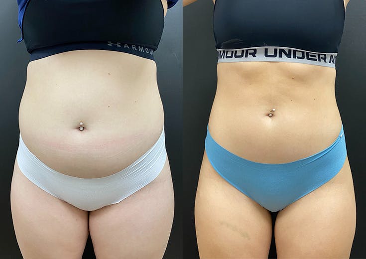 Morpheus8 for Body Before & After Gallery - Patient 248458 - Image 1