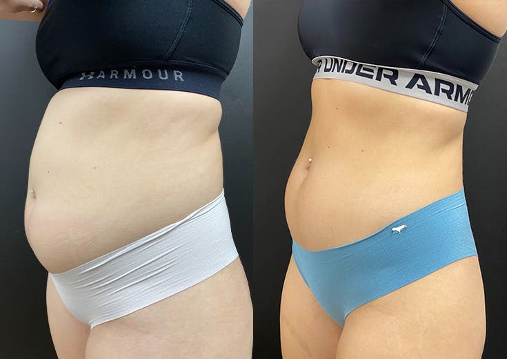 Morpheus8 for Body Before & After Gallery - Patient 248458 - Image 2