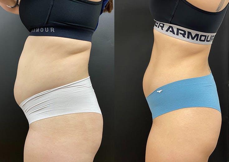 Morpheus8 for Body Before & After Gallery - Patient 248458 - Image 3