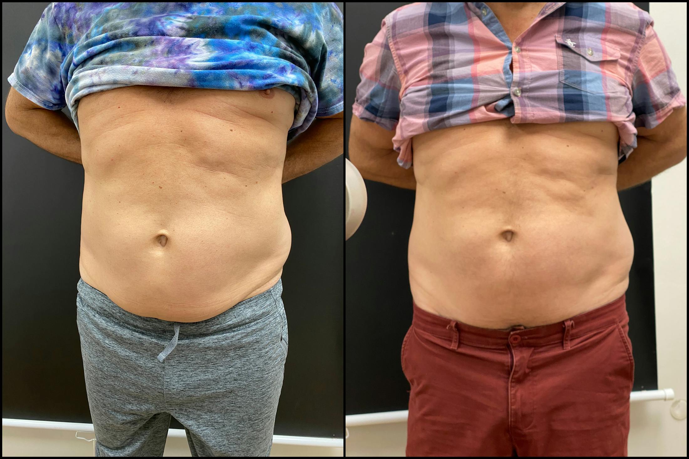 EvolveX Before & After Gallery - Patient 113765 - Image 1