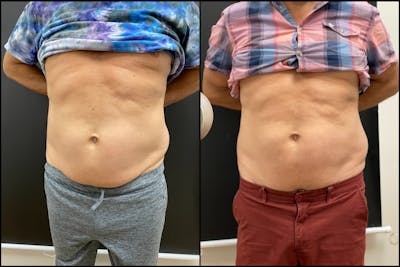 EvolveX Before & After Gallery - Patient 113765 - Image 1