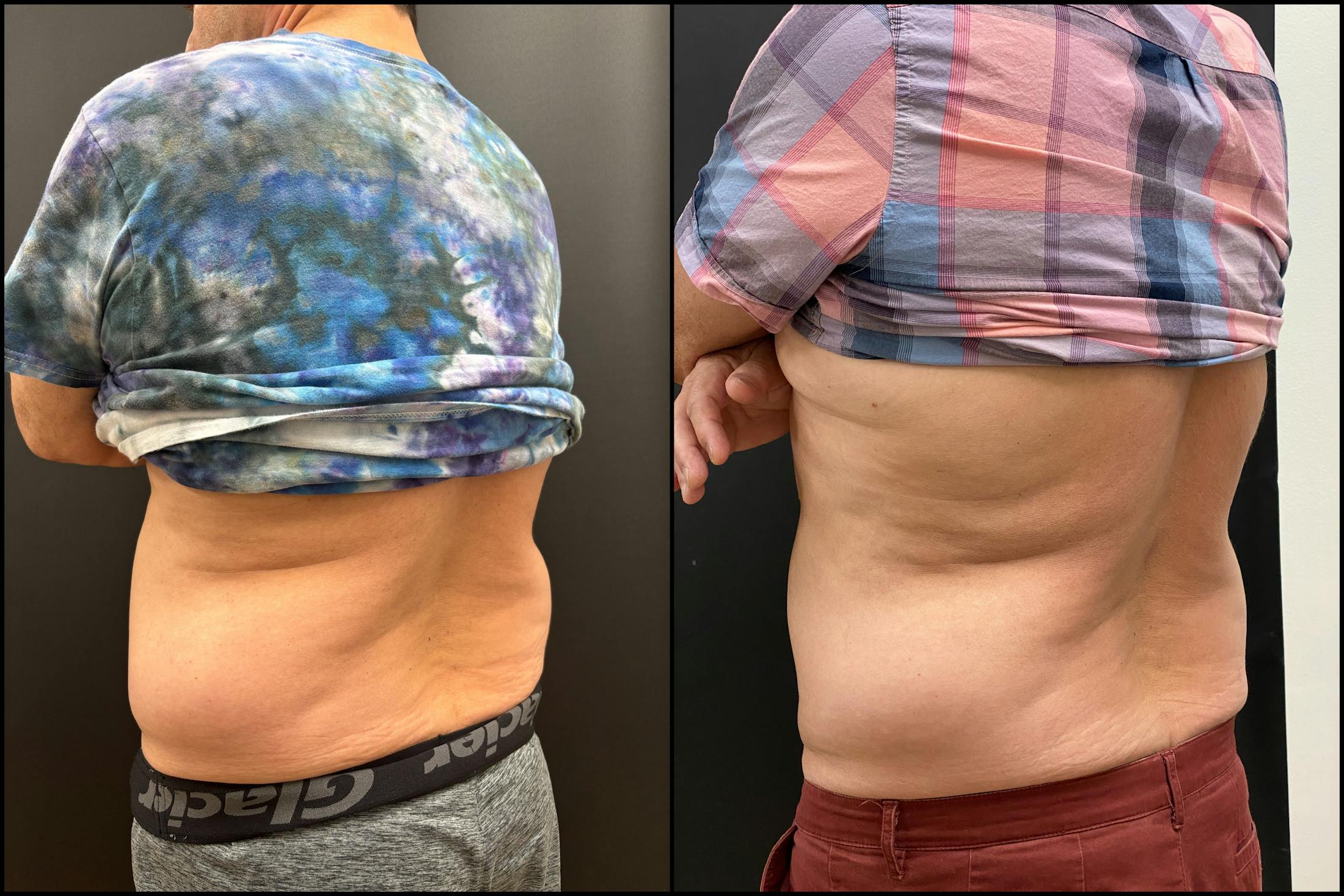 EvolveX Before & After Gallery - Patient 113765 - Image 3