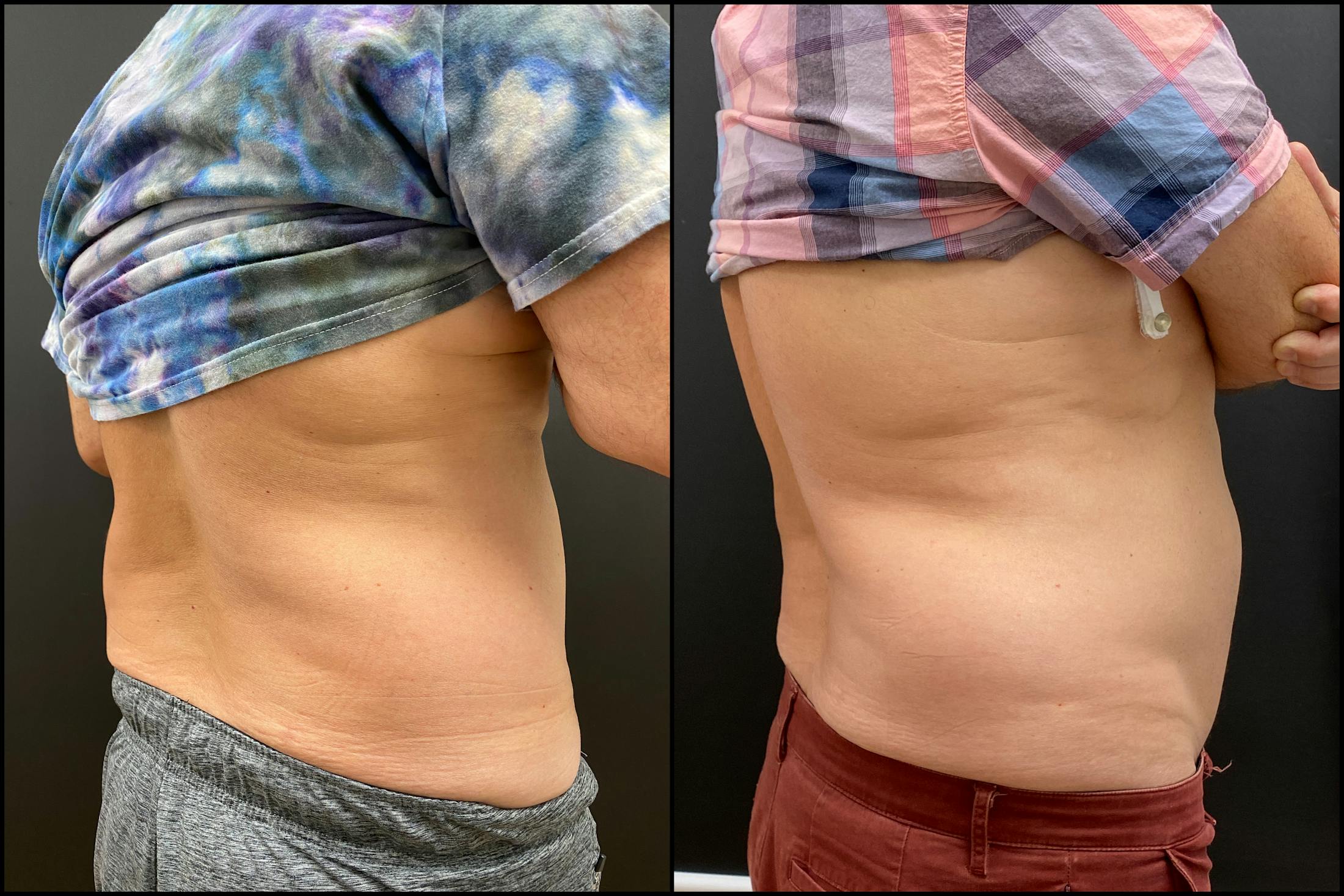 EvolveX Before & After Gallery - Patient 113765 - Image 2